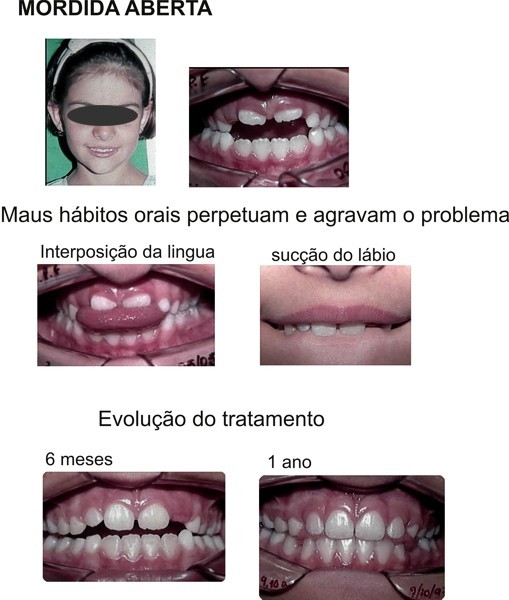 mordidaberta